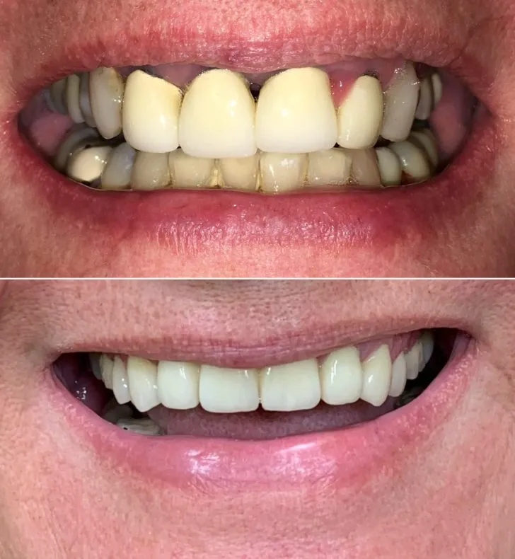 Implant bridge/ restoration