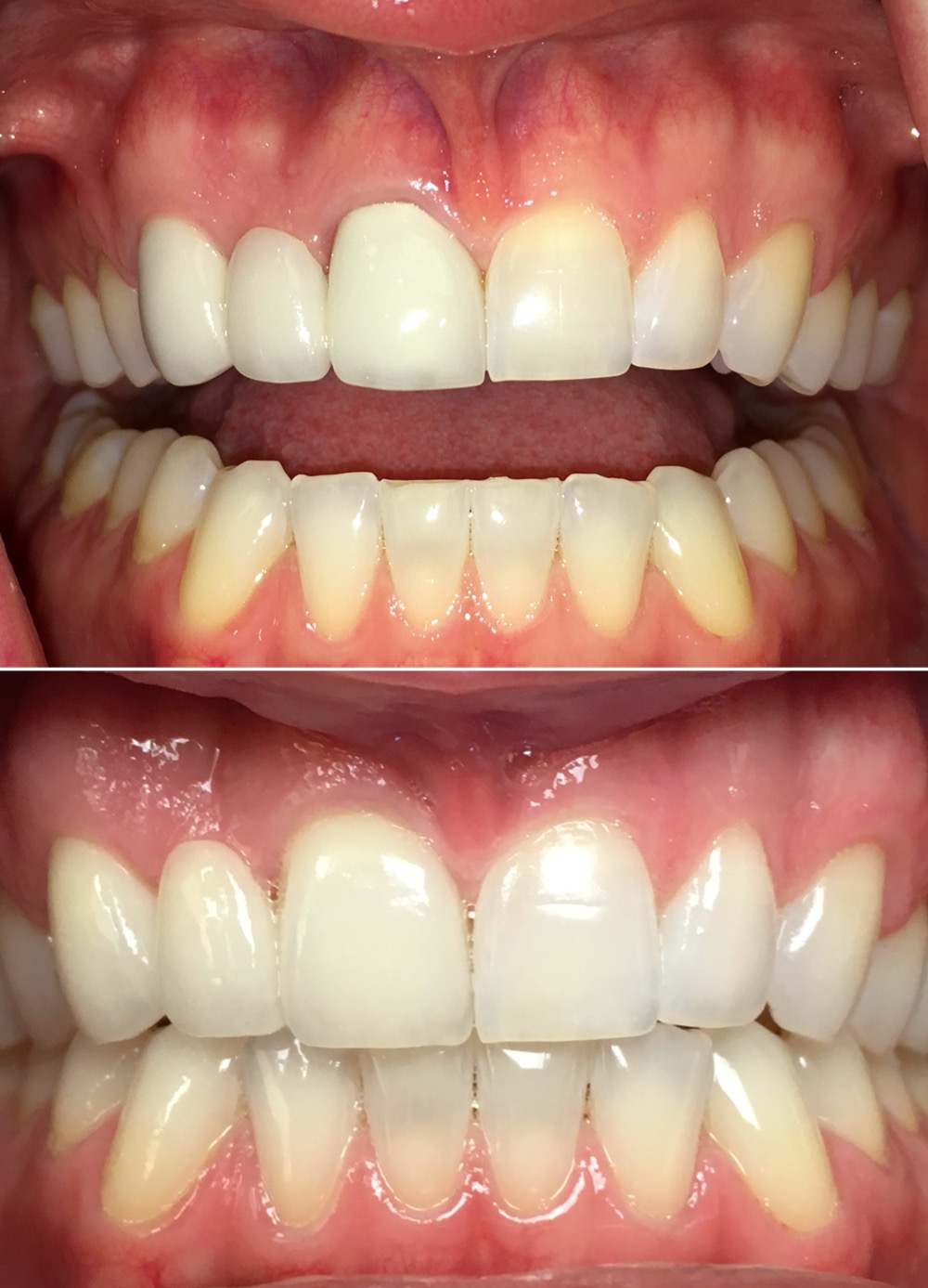 Replacement of existing bridge on natural teeth