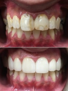 Dental crowns pic