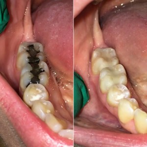 Dental FIllings
