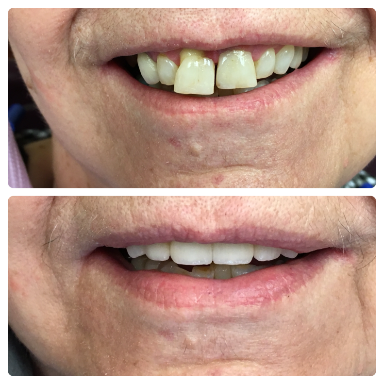 Fixed bridge on natural teeth