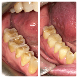 dental crowns